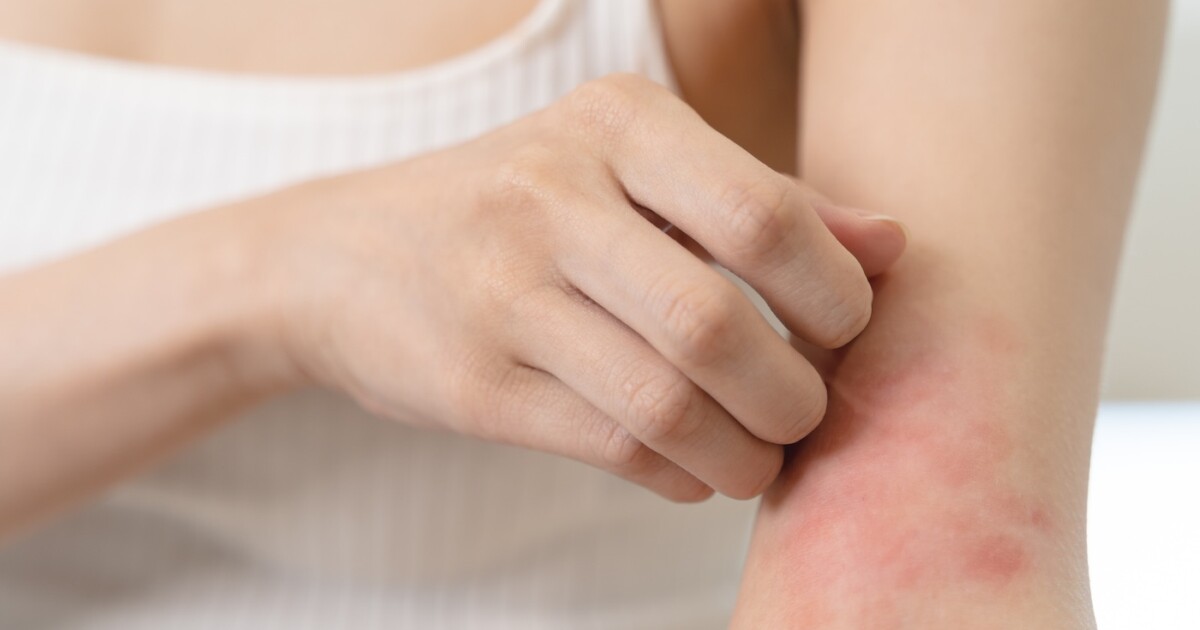 Concept allergique à la peau sensible, les démangeaisons de la femme sur son bras ont une éruption rouge due à un symptôme d'allergie et à des rayures.