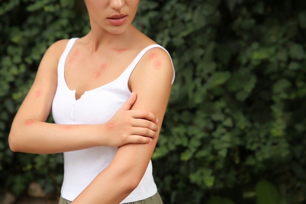 Femme se grattant le bras avec des piqûres d'insectes dans le parc, en gros plan.